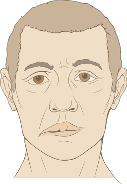 bell's palsy