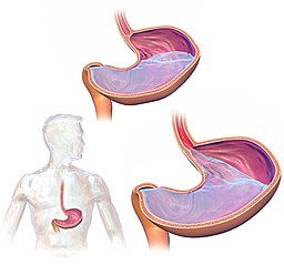 GastroEsophageal Reflux Disease GERD can lead to hoarseness