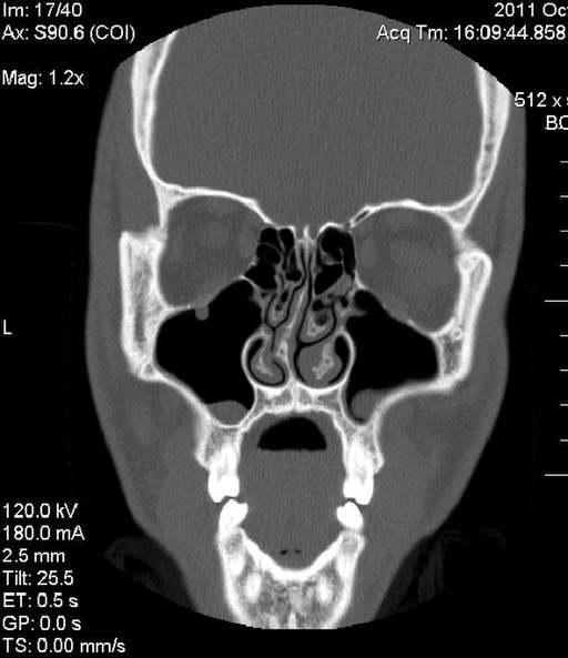 deviated septum and tinnitus? : r/tinnitus