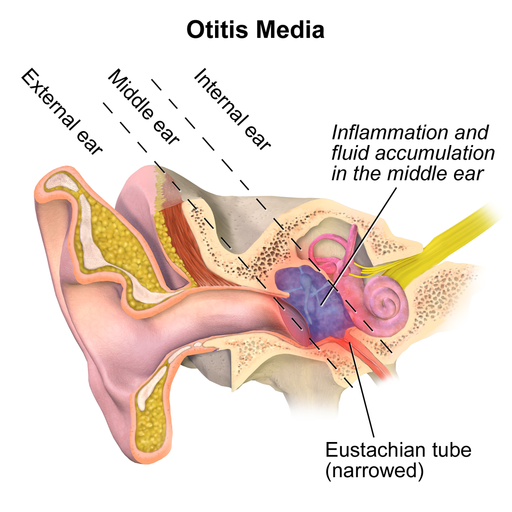 Ear Tubes for Unresponsive Otitis Media